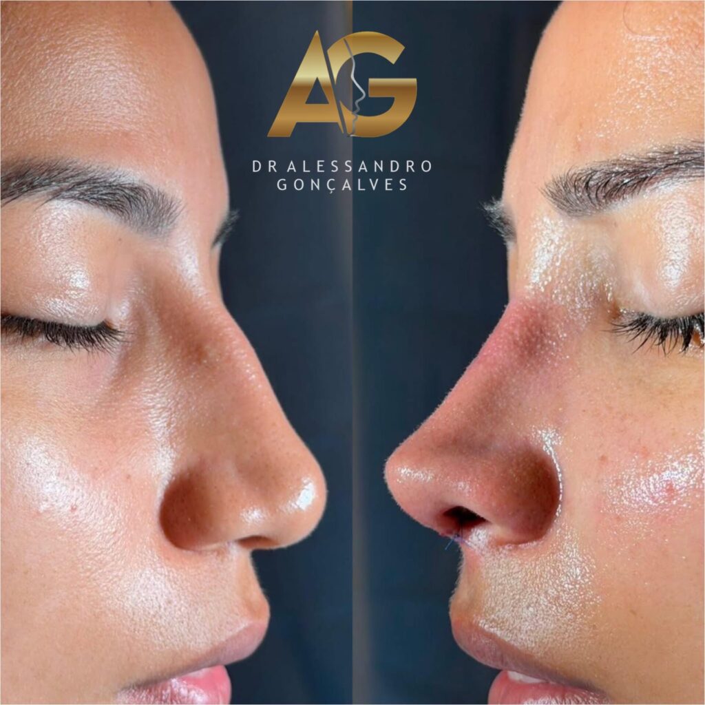 Antes e depois de rinoplastia em Rio Claro